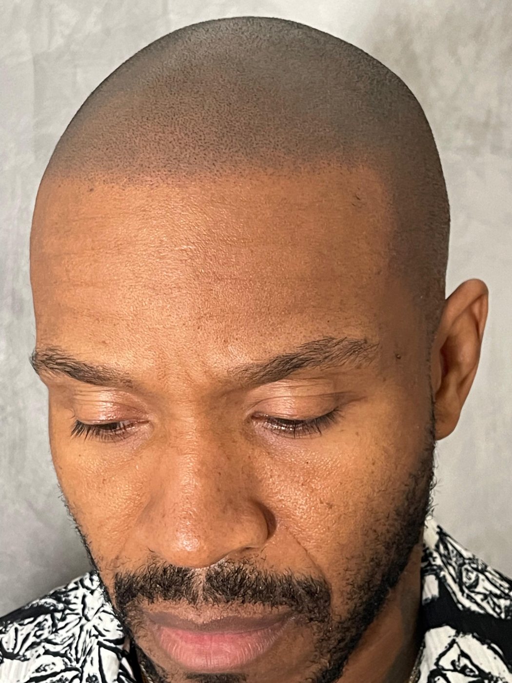 Full-scalp buzz-cut scalp micropigmentation result by Picasso Jeff