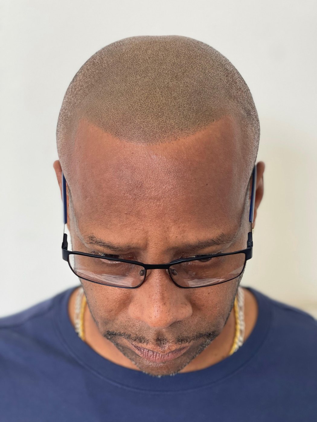 Crown density scalp micropigmentation by Picasso Jeff